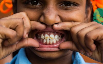 Fluorosis in Gujarat: A Disaster Ahead